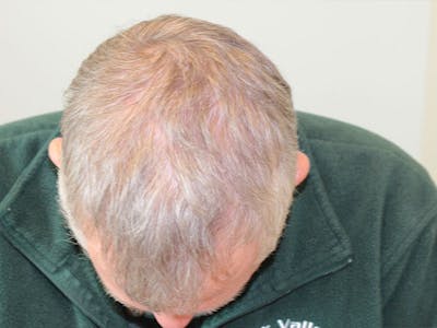 Facial Reconstruction Before & After Gallery - Patient 358071 - Image 2