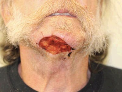 Facial Reconstruction Before & After Gallery - Patient 320105 - Image 1