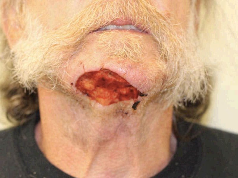 Facial Reconstruction Before & After Gallery - Patient 320105 - Image 1