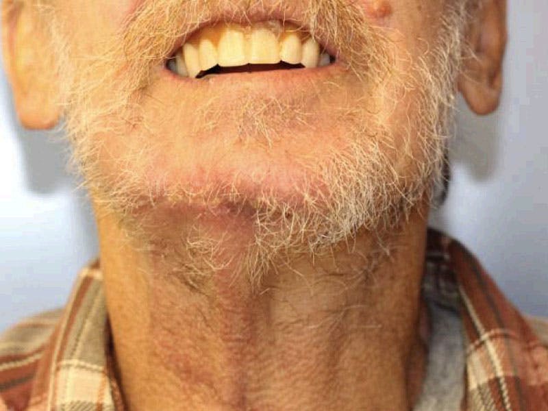 Facial Reconstruction Before & After Gallery - Patient 320105 - Image 2