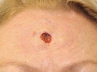 Facial Reconstruction Before & After Gallery - Patient 430170 - Image 1