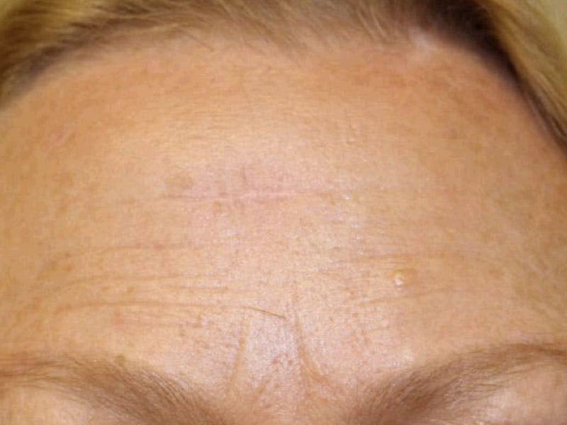 Facial Reconstruction Before & After Gallery - Patient 430170 - Image 2