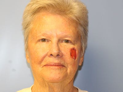 Facial Reconstruction Before & After Gallery - Patient 393365 - Image 1