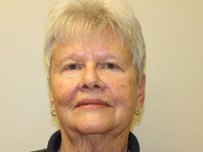 Facial Reconstruction Before & After Gallery - Patient 393365 - Image 2