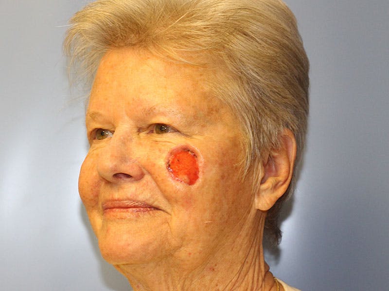 Facial Reconstruction Before & After Gallery - Patient 393365 - Image 3