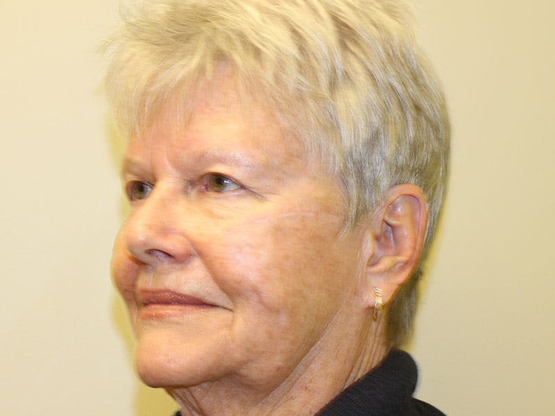 Facial Reconstruction Before & After Gallery - Patient 393365 - Image 4