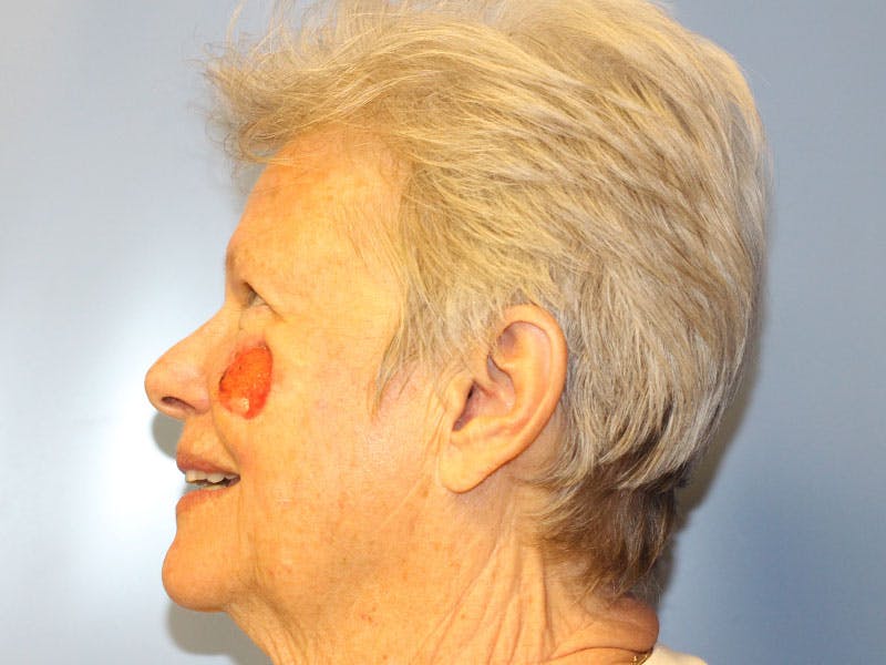 Facial Reconstruction Before & After Gallery - Patient 393365 - Image 5