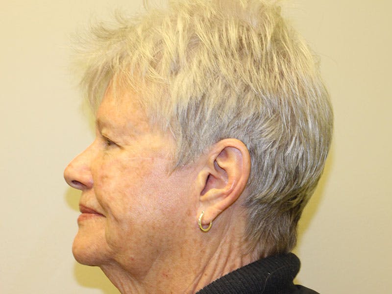 Facial Reconstruction Before & After Gallery - Patient 393365 - Image 6