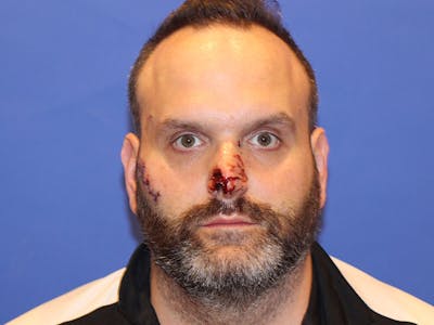 Nasal Reconstruction Before & After Gallery - Patient 406100 - Image 1