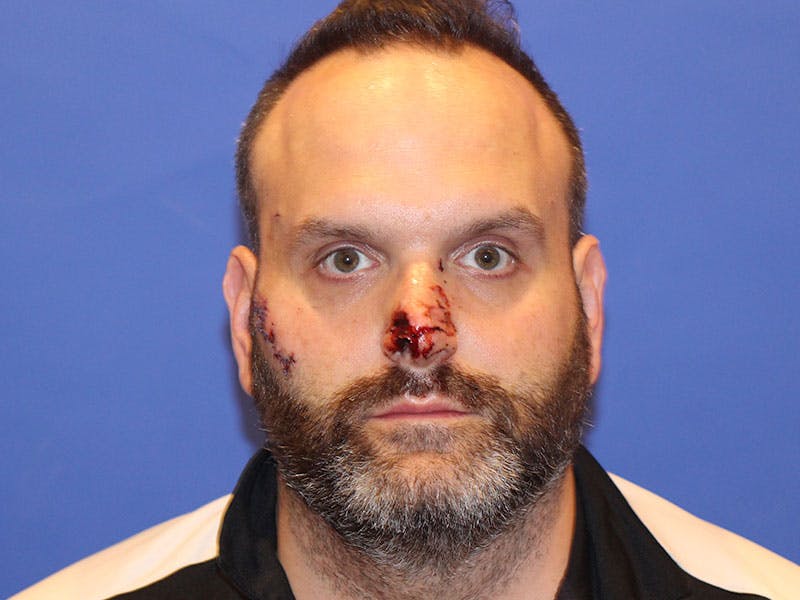 Nasal Reconstruction Before & After Gallery - Patient 406100 - Image 1