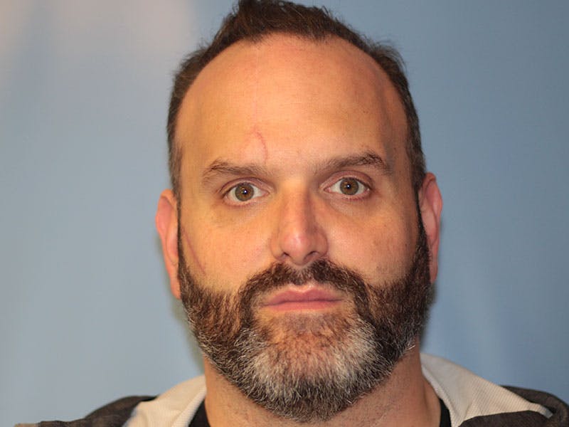 Nasal Reconstruction Before & After Gallery - Patient 406100 - Image 2