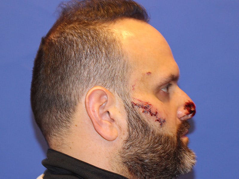 Nasal Reconstruction Before & After Gallery - Patient 406100 - Image 3