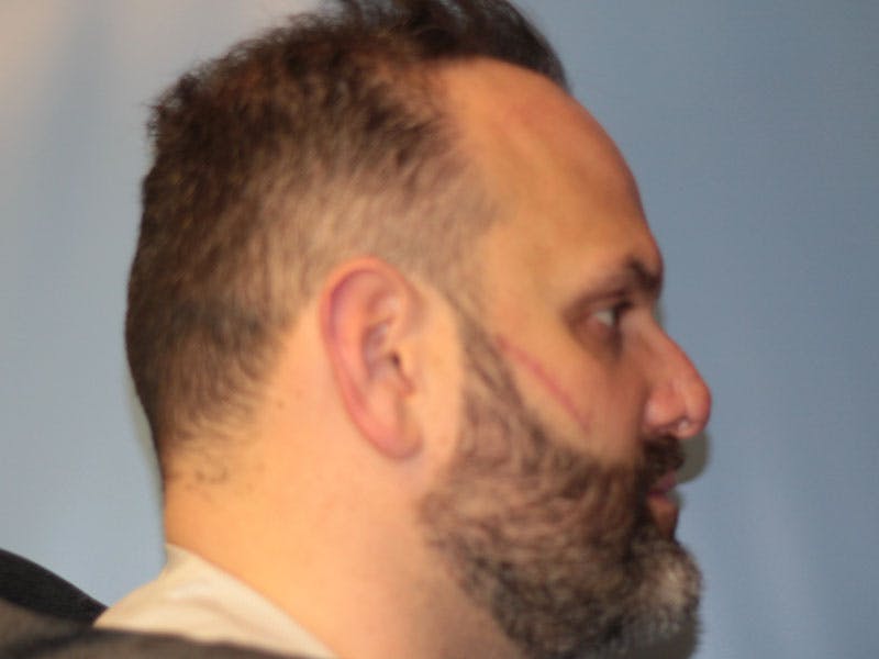 Nasal Reconstruction Before & After Gallery - Patient 406100 - Image 4