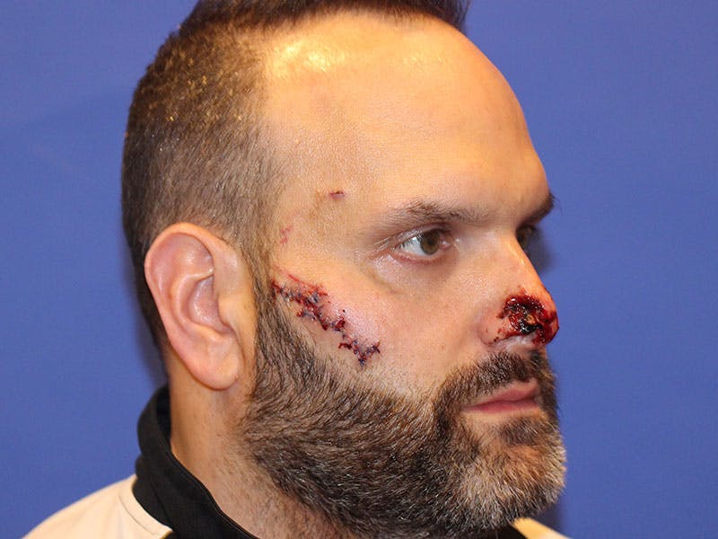 Nasal Reconstruction Before & After Gallery - Patient 406100 - Image 5