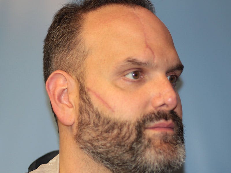 Nasal Reconstruction Before & After Gallery - Patient 406100 - Image 6