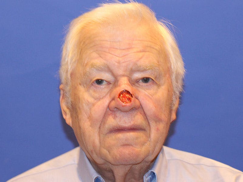 Nasal Reconstruction Before & After Gallery - Patient 348442 - Image 1