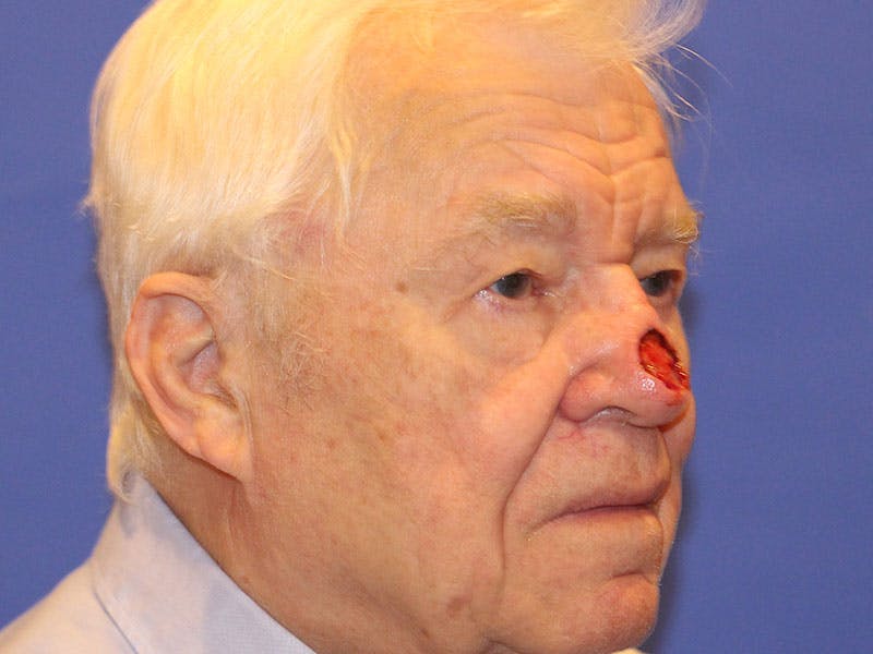 Nasal Reconstruction Before & After Gallery - Patient 348442 - Image 3