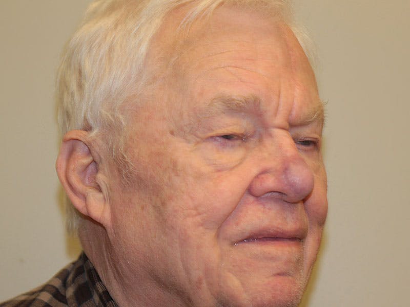 Nasal Reconstruction Before & After Gallery - Patient 348442 - Image 4