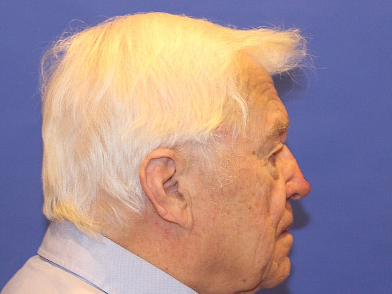 Nasal Reconstruction Before & After Gallery - Patient 348442 - Image 5