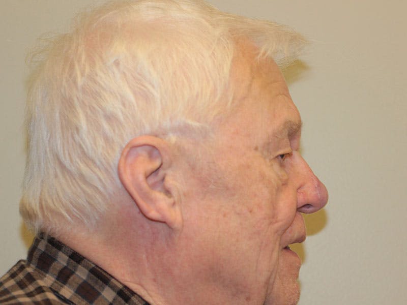 Nasal Reconstruction Before & After Gallery - Patient 348442 - Image 6