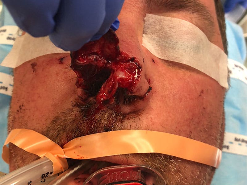 Nasal Reconstruction Before & After Gallery - Patient 981910 - Image 1