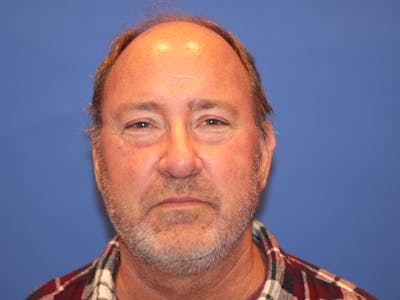 Nasal Reconstruction Before & After Gallery - Patient 981910 - Image 2