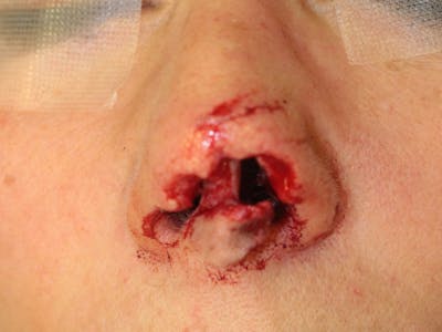 Nasal Reconstruction Before & After Gallery - Patient 364283 - Image 1