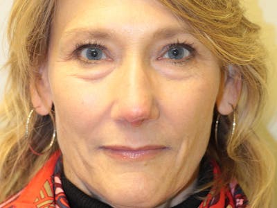 Nasal Reconstruction Before & After Gallery - Patient 364283 - Image 2