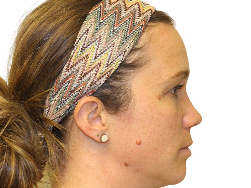 Moles And Cysts Before & After Gallery - Patient 327728 - Image 1