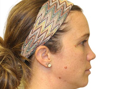 Moles And Cysts Before & After Gallery - Patient 327728 - Image 1