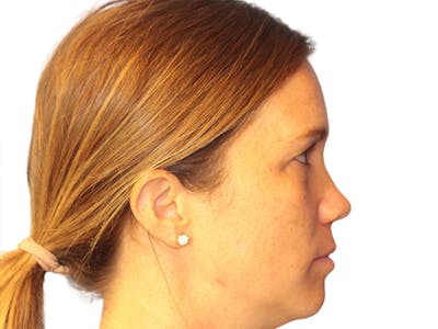 Moles And Cysts Before & After Gallery - Patient 327728 - Image 2