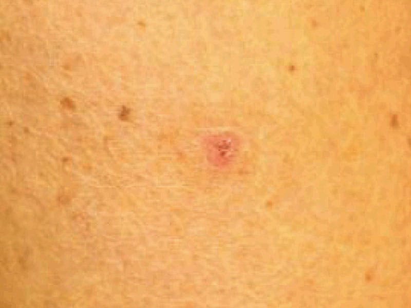 Moles And Cysts Before & After Gallery - Patient 353809 - Image 1