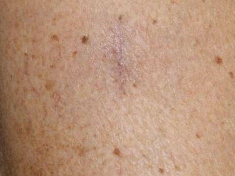 Moles And Cysts Before & After Gallery - Patient 353809 - Image 2