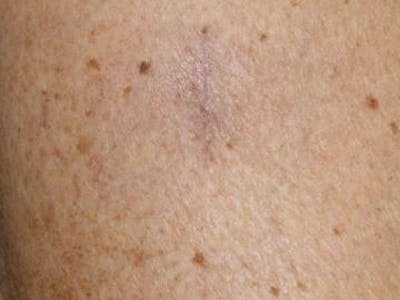 Moles And Cysts Before & After Gallery - Patient 353809 - Image 2