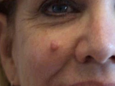 Moles And Cysts Before & After Gallery - Patient 401295 - Image 1
