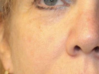 Moles And Cysts Before & After Gallery - Patient 401295 - Image 2