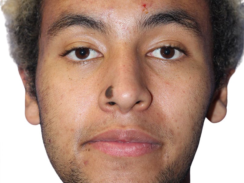 Moles And Cysts Before & After Gallery - Patient 808826 - Image 1