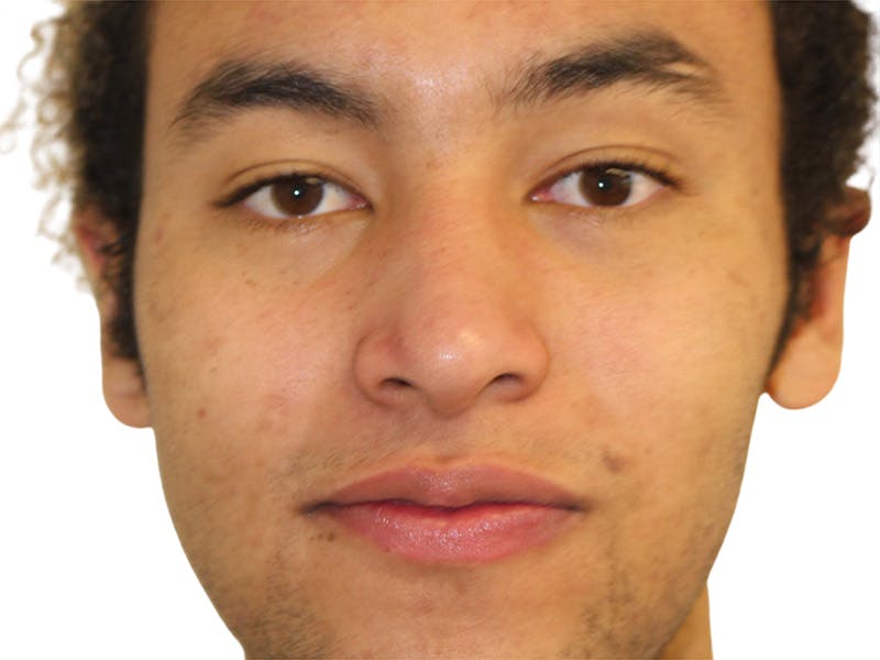 Moles And Cysts Before & After Gallery - Patient 808826 - Image 2