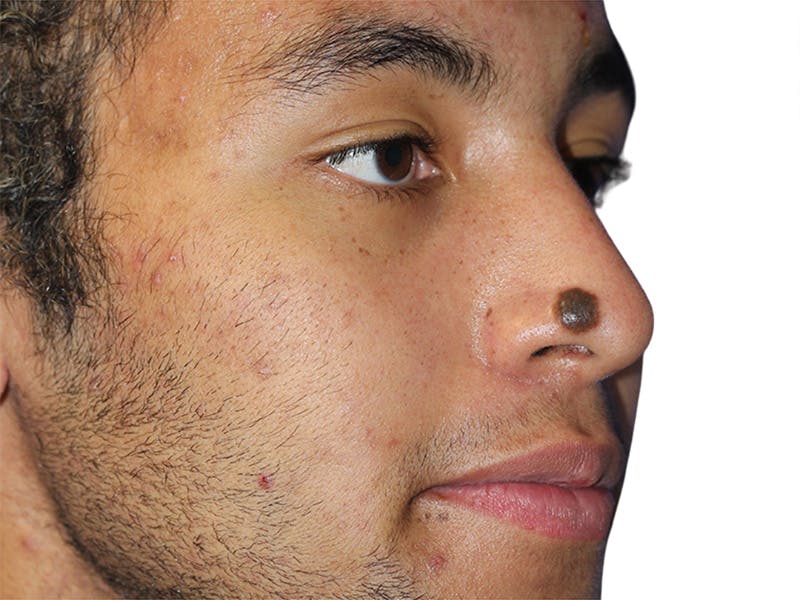 Moles And Cysts Before & After Gallery - Patient 808826 - Image 3