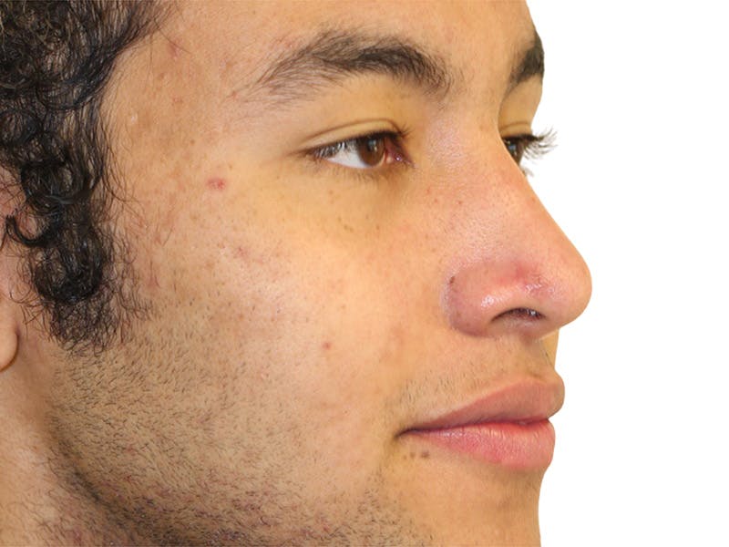 Moles And Cysts Before & After Gallery - Patient 808826 - Image 4