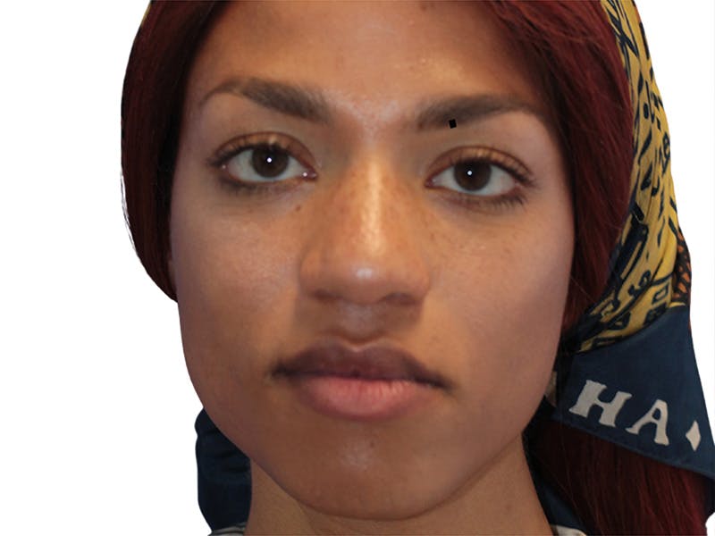 Facial Feminization Before & After Gallery - Patient 127806 - Image 1