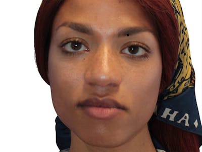 Facial Feminization Before & After Gallery - Patient 127806 - Image 1