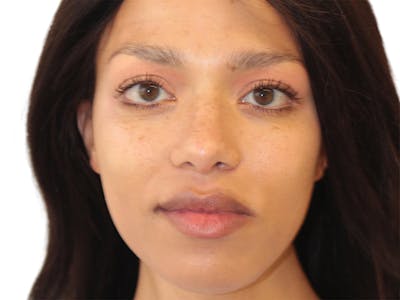 Facial Feminization Before & After Gallery - Patient 127806 - Image 2