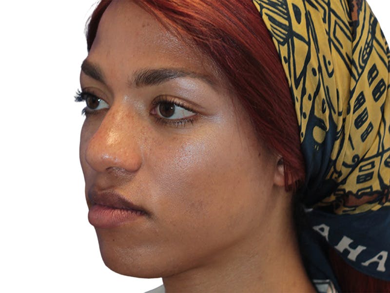 Facial Feminization Before & After Gallery - Patient 127806 - Image 3