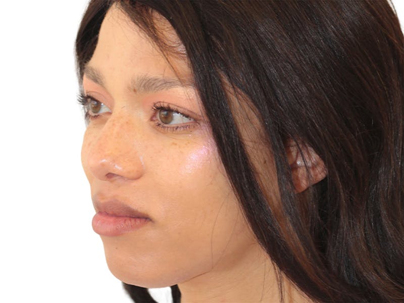 Facial Feminization Before & After Gallery - Patient 127806 - Image 4