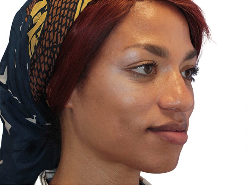 Facial Feminization Before & After Gallery - Patient 127806 - Image 5