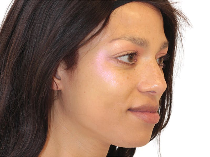 Facial Feminization Before & After Gallery - Patient 127806 - Image 6