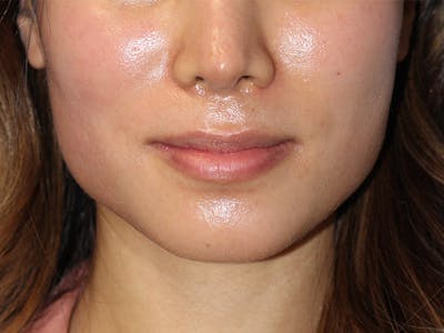 Lip Lift Before & After Gallery - Patient 299577 - Image 1