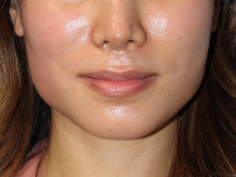 Lip Lift Before & After Gallery - Patient 299577 - Image 1