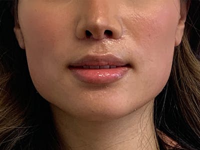 Lip Lift Before & After Gallery - Patient 299577 - Image 2